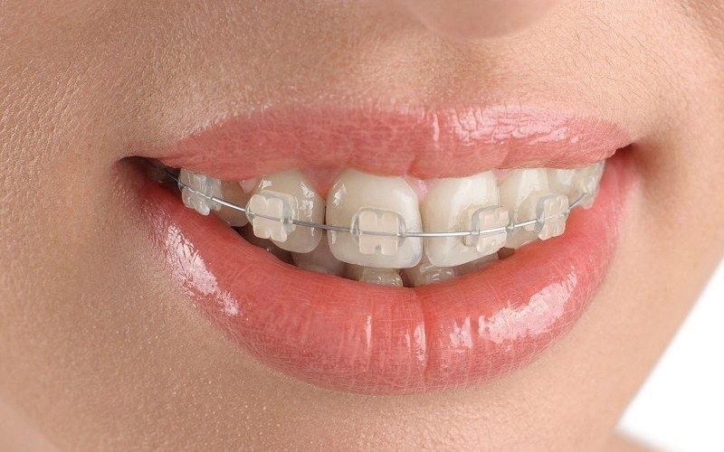 Niềng răng mắc cài sứ có chi phí thực hiện cao