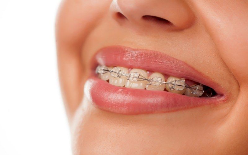 Niềng răng mắc cài sứ có tính thẩm mỹ vượt trội