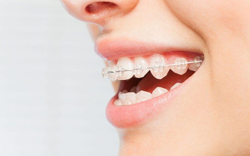 Niềng răng mắc cài sứ  dao động từ khoảng 37.000.000 đồng - 54.000.000 đồng