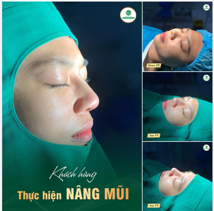 "Cực cuốn" với kết quả nâng mũi bọc sụn Megaderm tại BV