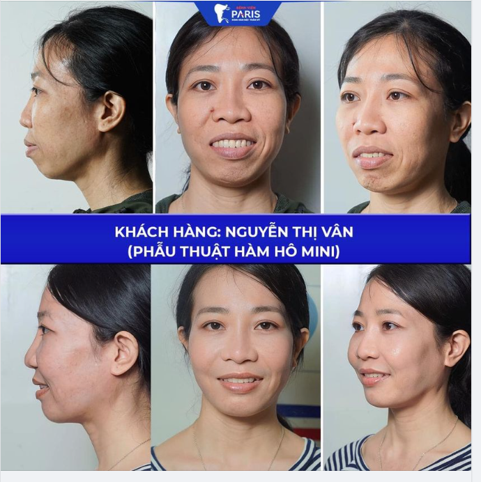 CHỈNH HÀM HÔ MINI CAN THIỆP TỐI THIỂU HIỆU QUẢ TỐI ĐA