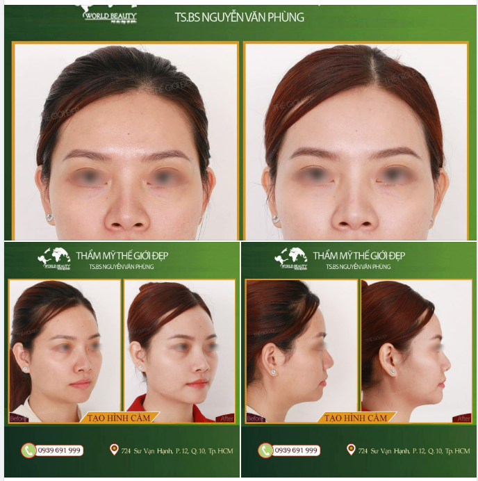 Độn cằm một lần có ngay đường nét mặt chuẩn tỷ lệ vàng lâu dài 