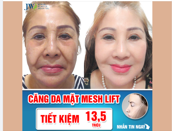 CĂNG DA MẶT MESH LIFT - LÀN DA CĂNG TRÀN KHÔNG TUỔI