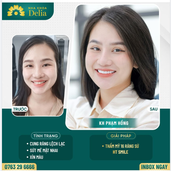 Bọc 16 răng sứ HT Smile - Khắc phục răng xỉn màu, sứt mẻ mặt nhai