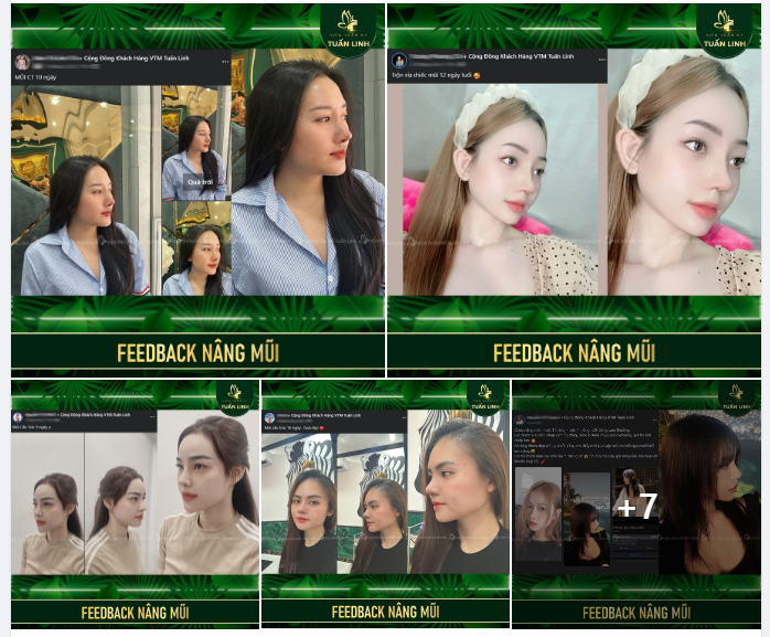 FEEDBACK NÂNG MŨI TỪ KHÁCH HÀNG TUẤN LINH.