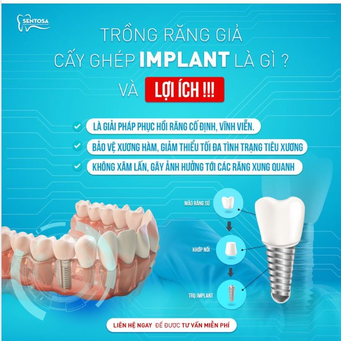 TRỒNG RĂNG GIẢ- CẤY GHÉP IMPLANT LÀ GÌ VÀ LỢI ÍCH !!!