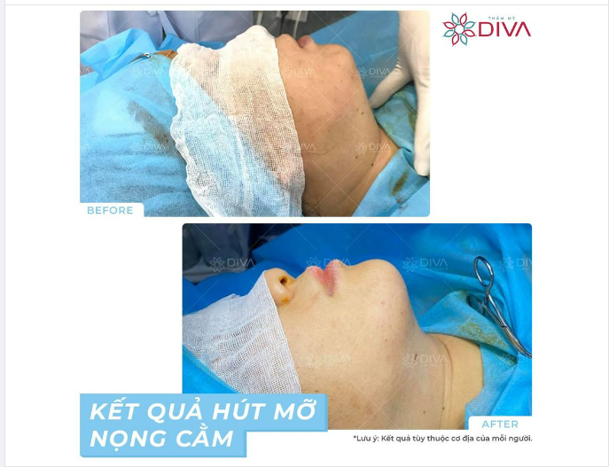 SAU GIẢM MỠ NỌNG CẰM: CẰM GỌN VLINE THANH THOÁT