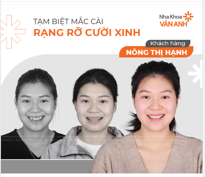 KHẤP KHỂNH CƯỜI DUYÊN HAY RĂNG ĐỀU TĂM TẮP