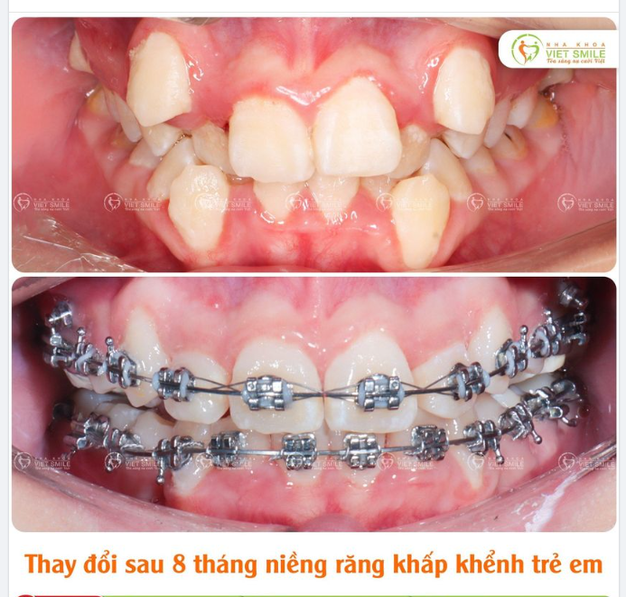 THAY ĐỔI SAU 8 THÁNG NIỀNG RĂNG KHẤP KHỂNH TRẺ EM