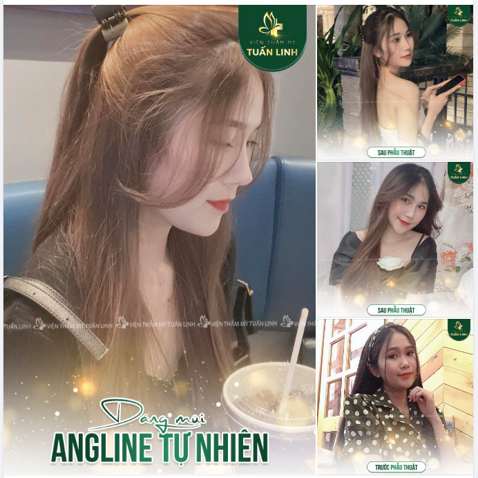 Khách hàng 9x xinh đẹp rạng ngời với chiếc mũi Angel line cao tự nhiên.