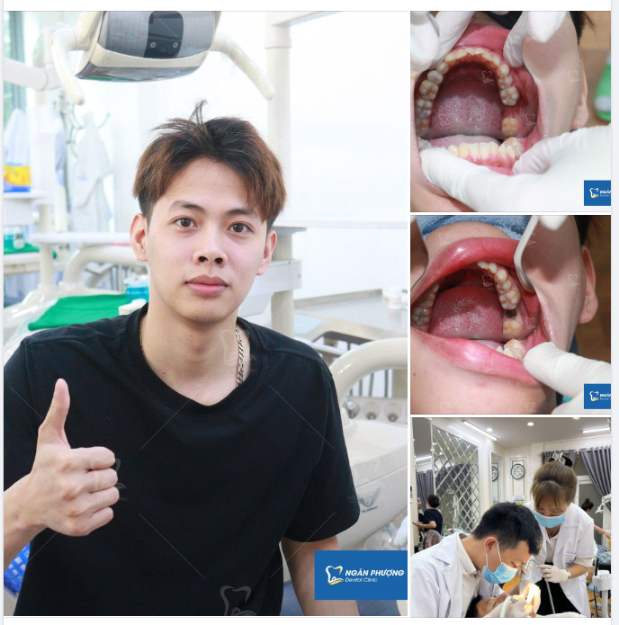 Mất răng có thể xảy ra ở mọi độ tuổi không kể già trẻ do tai nạn, cơ địa hoặc những vấn đề khác về vệ sinh răng.
