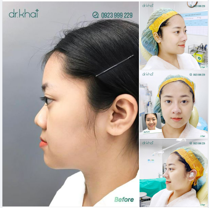 DÁNG MŨI XUẤT SẮC - HẾT TỰ TI VÌ CÁNH MŨI TO BÈ, SÓNG MŨI THẤP