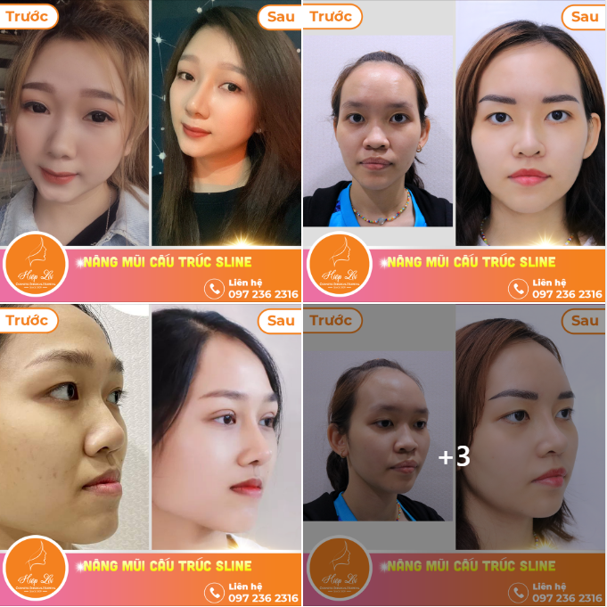 Nâng mũi cấu trúc- Nâng tẩm nhan sắc