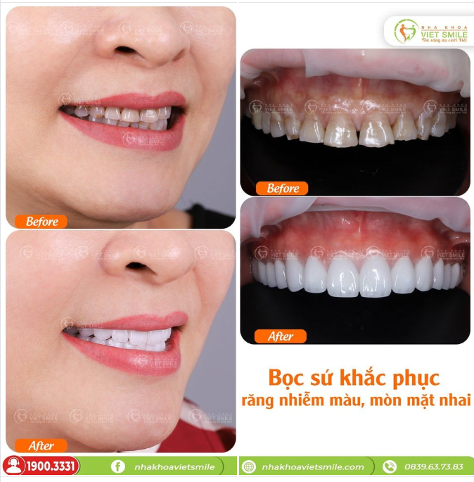 BỌC SỨ KHẮC PHỤC RĂNG NHIỄM KHÁNG SINH, MÒN MẶT NHAI