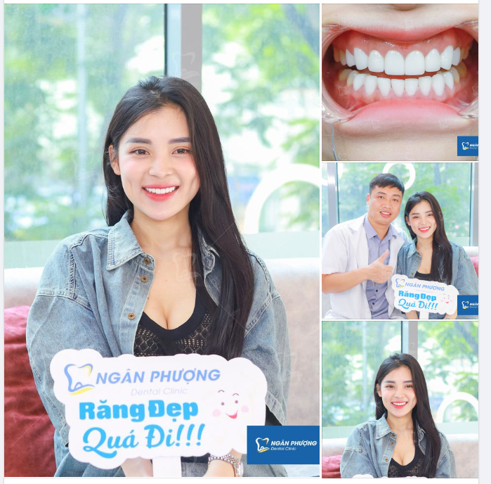 Tái khám răng sứ cho chị Ngọc Linh - vợ anh Huấn Hoa Hồng