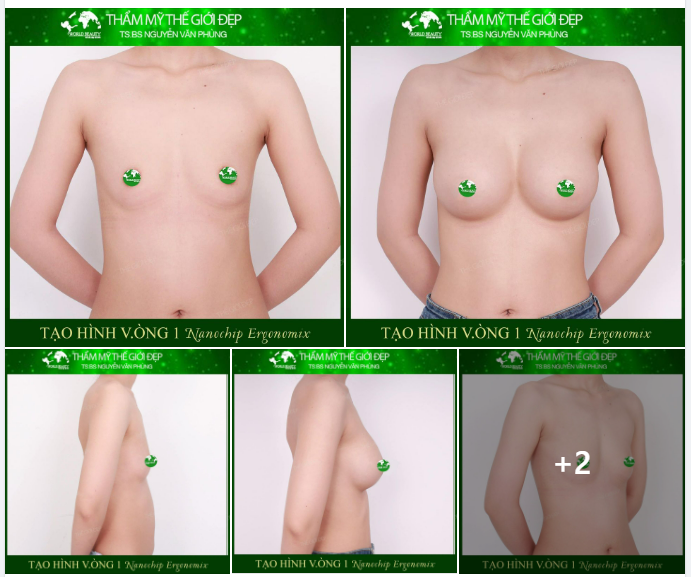 V.òng 1 của khách hàng trước ph.ẫu th.uật nhỏ, lép; không đều nhau; mô tuyết vú ít...