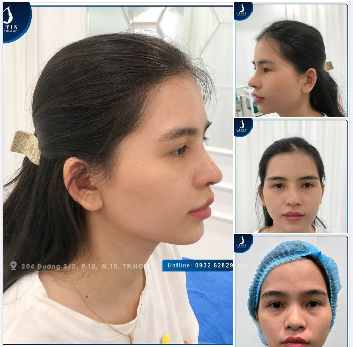 Tái khám mũi cấu trúc sau 7 ngày và Cái kết ngọt ngào