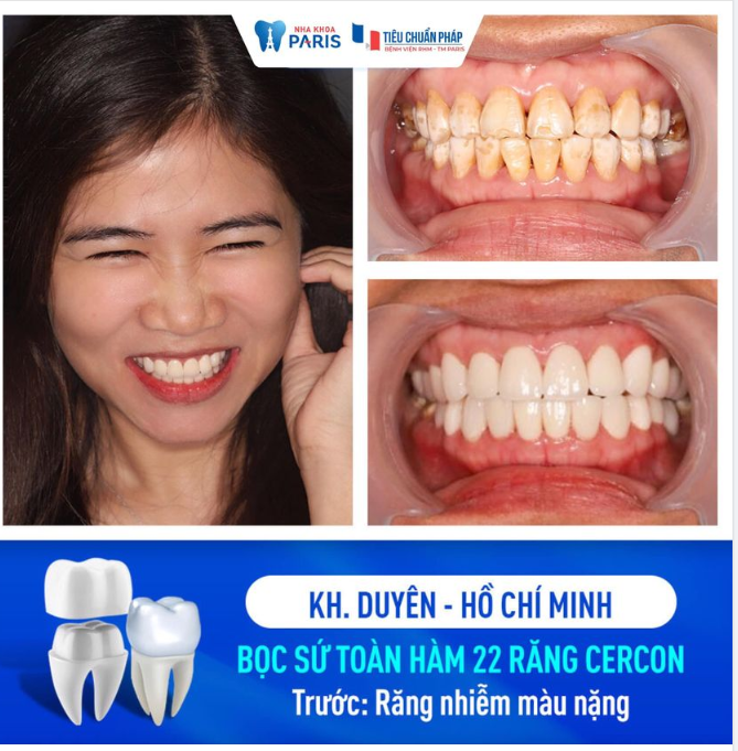 BỌC 22 RĂNG SỨ CERCON CHO KH RĂNG NHIỄM MÀU NẶNG