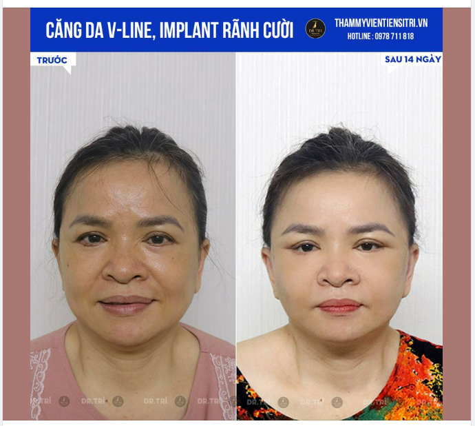KHÁC BIỆT RÕ RỆT SAU CĂNG DA VLINE tại Dr Trí