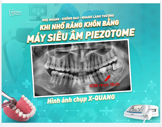 NHẸ NHÀNG - KHÔNG ĐAU - NHANH LÀNH THƯƠNG KHI NHỔ RĂNG KHÔN BẰNG MÁY SIÊU ÂM PIEZOTOME