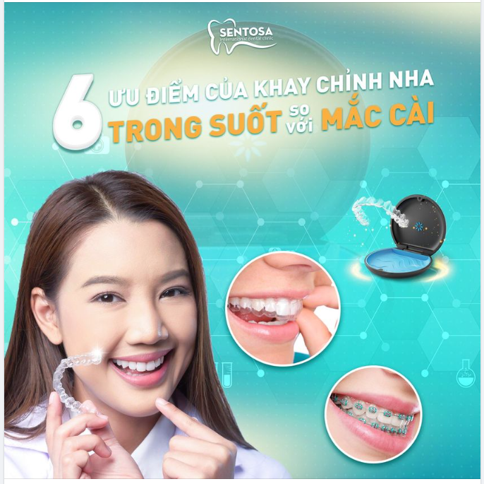 6 ƯU ĐIỂM CỦA KHAY CHỈNH NHA TRONG SUỐT INVISALIGN SO VỚI MẮC CÀI