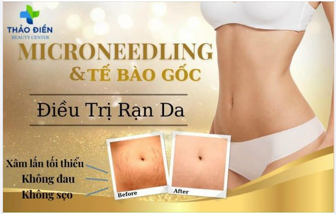 MICRONEEDLING là phương pháp thẩm mỹ trị rạn da bằng máy laser kết hợp với điện di tế bào gốc
