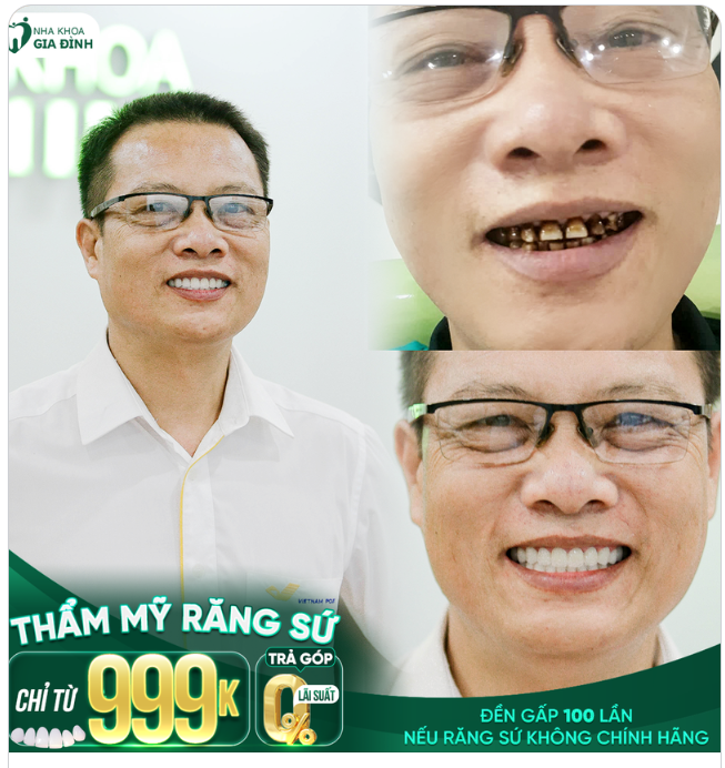 RĂNG NHIỄM MÀU ĐẶC BIỆT NGHIÊM TRỌNG KHẮC PHỤC CHỈ SAU 2 LẦN HẸN