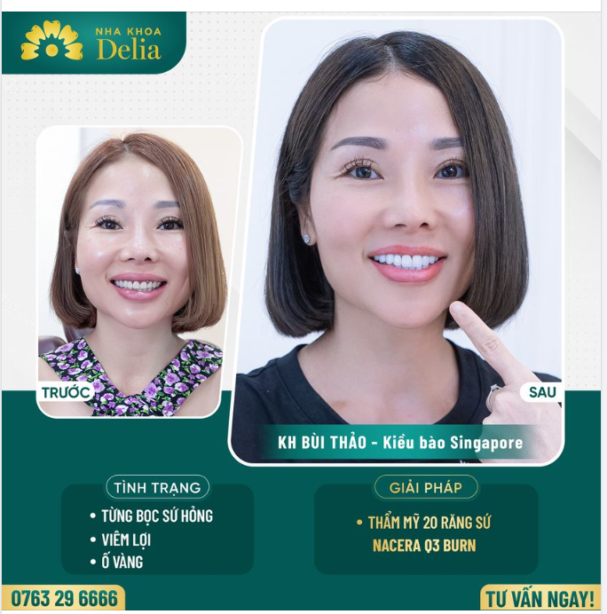 Thẩm mỹ răng sứ - Khắc phục răng sứ hỏng cho kiều bào Singapore