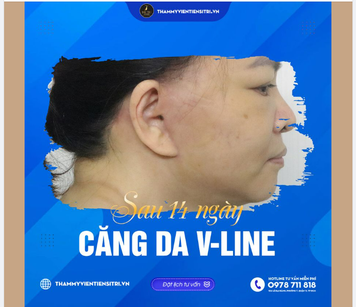 SẸO NHƯ CÓ NHƯ KHÔNG MÀ THÔI!!