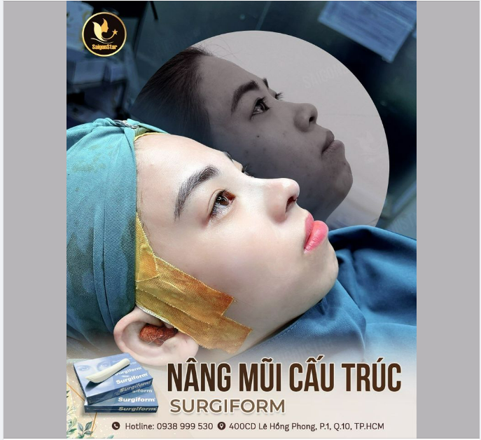 60 PHÚT NÂNG MŨI CẤU TRÚC SỤN SURGIFORM