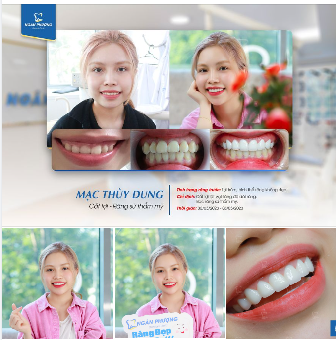 Làm sứ một hàm thì xinh  Kết hợp cắt lợi đẹp xinh nhiều lần