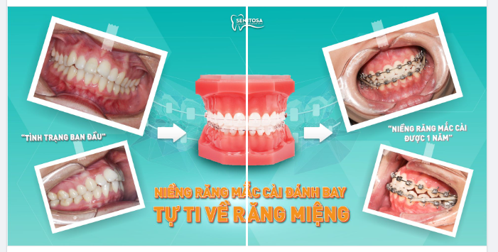 FEEDBACK KHÁCH HÀNG NIỀNG RĂNG MẮC CÀI TẠI SENTOSA