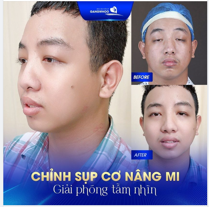 Bạn khách hàng Trần Thanh Phúc (23 tuổi) đến từ Kiên Giang bị sụp cơ nâng mi bẩm sinh khiến đôi mắt trông lúc nào cũng lờ đờ và hạn chế tầm nhìn.