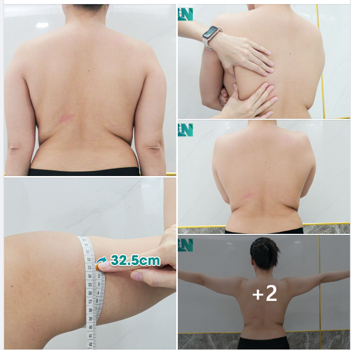 CÁNH TAY, LƯNG, NÁCH CHO CHỊ KH 9X: TIN TƯỞNG VÀ LỰA CHỌN EKIP CHUYÊN SÂU VÌ ĐƯỢC MỘT BÁC SĨ CHUYÊN KHOA KHÁC GIỚI THIỆU