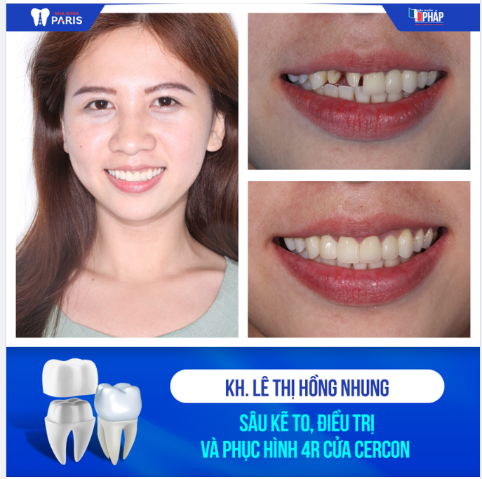 Lột xác 180 độ sau khi phục hình răng sứ thẩm mỹ tại Paris!