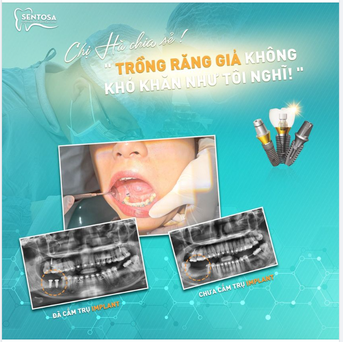 "TRỒNG RĂNG GIẢ KHÔNG KHÓ KHĂN NHƯ TÔI NGHĨ! "