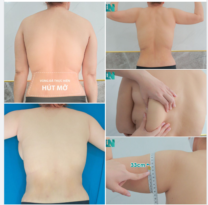  HÚT MỠ TẠO DÁNG THẨM MỸ VÙNG CÁNH TAY, LƯNG, NÁCH CHO CHỊ KH 7X, SINH SỐNG TẠI TPHCM, ĐÃ THỰC HIỆN HÚT MỠ BỤNG GẦN 2 TUẦN TRƯỚC. 
