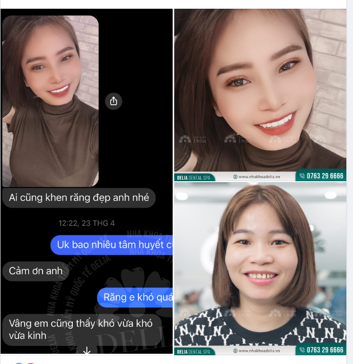 TRỞ THÀNH PHIÊN BẢN HOÀN HẢO SAU BỌC RĂNG SỨ TẠI DELIA