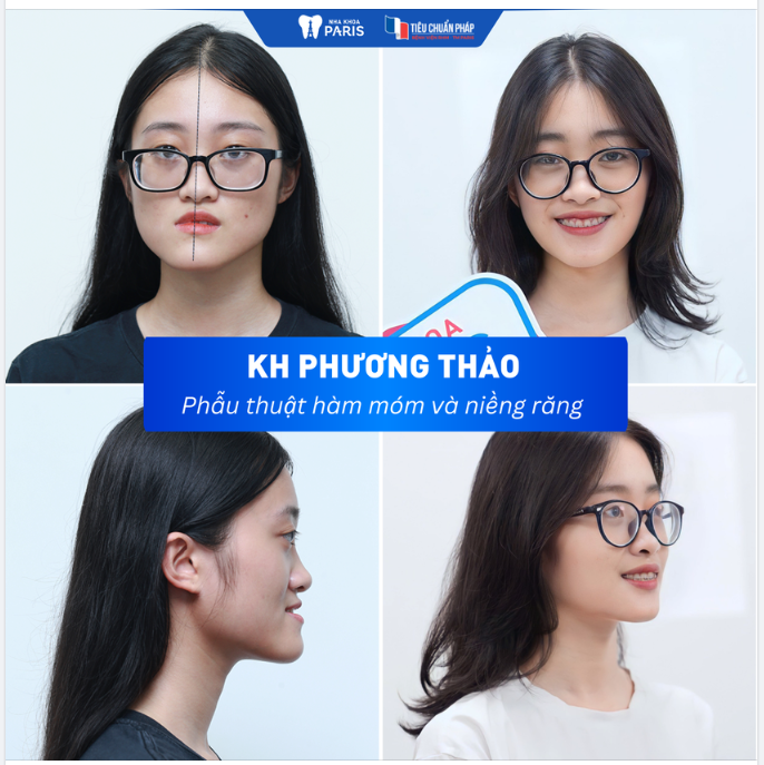 NGUYỄN PHƯƠNG THẢO - 20 TUỔI ĐÃ CÓ 1 CUỘC PHẪU THUẬT HÀM MÓM THAY ĐỔI CUỘC ĐỜI