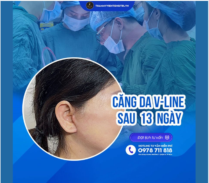 CHIÊM NGƯỠNG SẸO CĂNG DA VLINE SAU 13 NGÀY