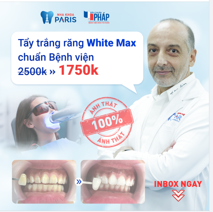 Răng ố vàng, xỉn màu do thực phẩm, thuốc lá