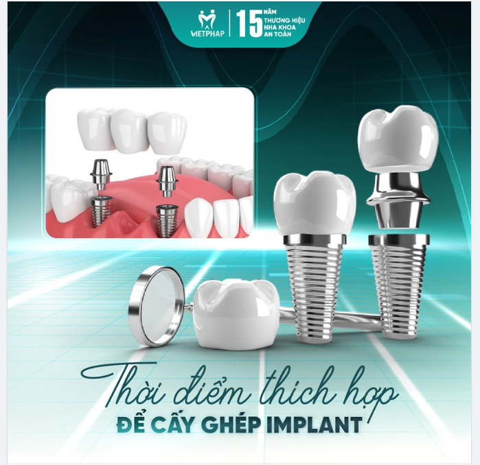 THỜI ĐIỂM THÍCH HỢP ĐỂ CẤY GHÉP IMPLANT