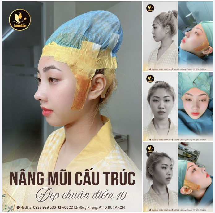 CẬN CẢNH CHIẾC MŨI CẤU TRÚC SAU 60 PHÚT THỰC HIỆN BỞI DR. HOẠT