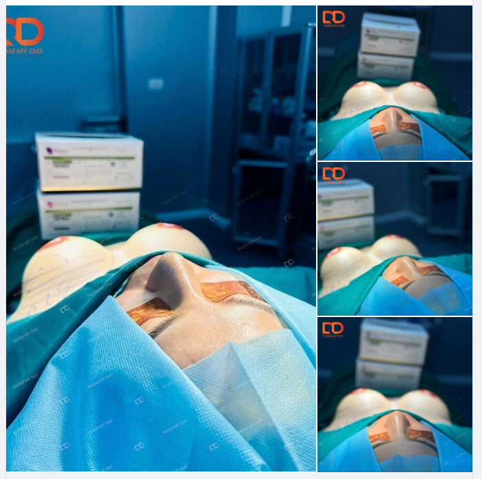 Kết quả Nâng ngực + Nâng mũi trong cùng 1 lần phẫu thuật.