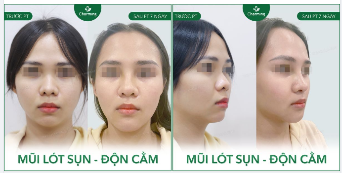 Khuôn mặt khách khá ngắn nhưng bạn khách này chủ yếu muốn làm lại chiếc mũi cho đẹp và cao hơn.
