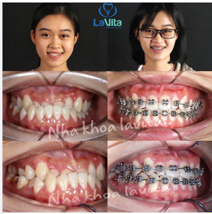 Khớp cắn ngược là một trong những trường hợp bất thường của răng, gây ảnh hưởng nghiêm trọng đến sức khoẻ và thẩm mỹ của người bệnh.