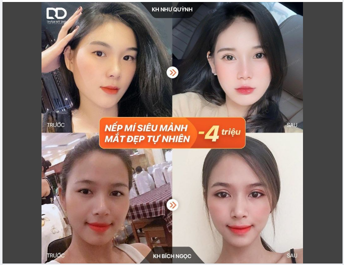 Chị em đang gặp tình trạng: 1 mí, mí lót, mí lệch, mí đã chỉnh sửa