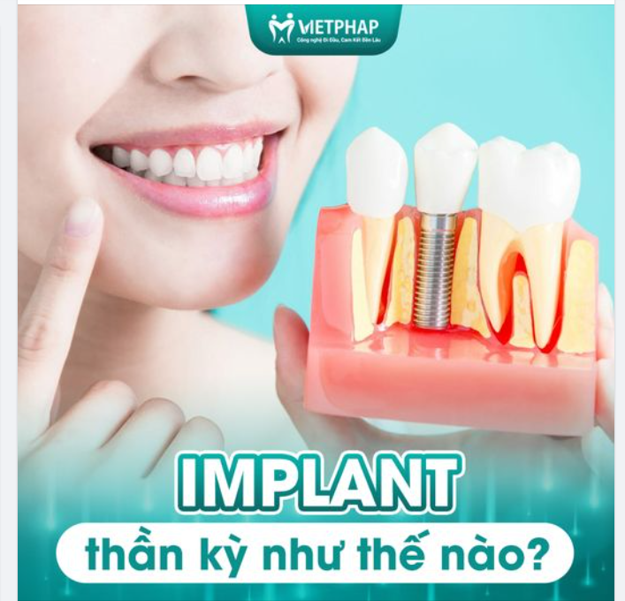 IMPLANT THẦN KỲ NHƯ THẾ NÀO?