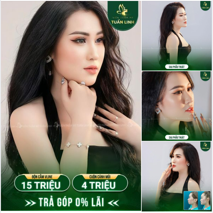 Độn cằm Vline:15TR - Đẹp tự nhiên - Hợp phong thủy.