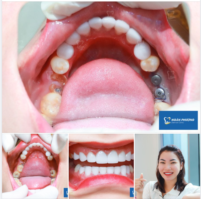 Trồng implant được ăn cả, ngã trả lại tiền